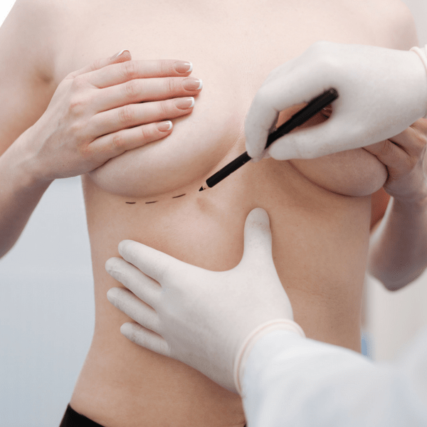 Breast augmentation 