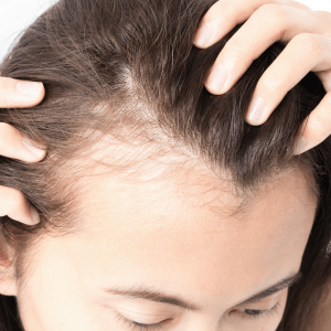 Types of Hair Loss