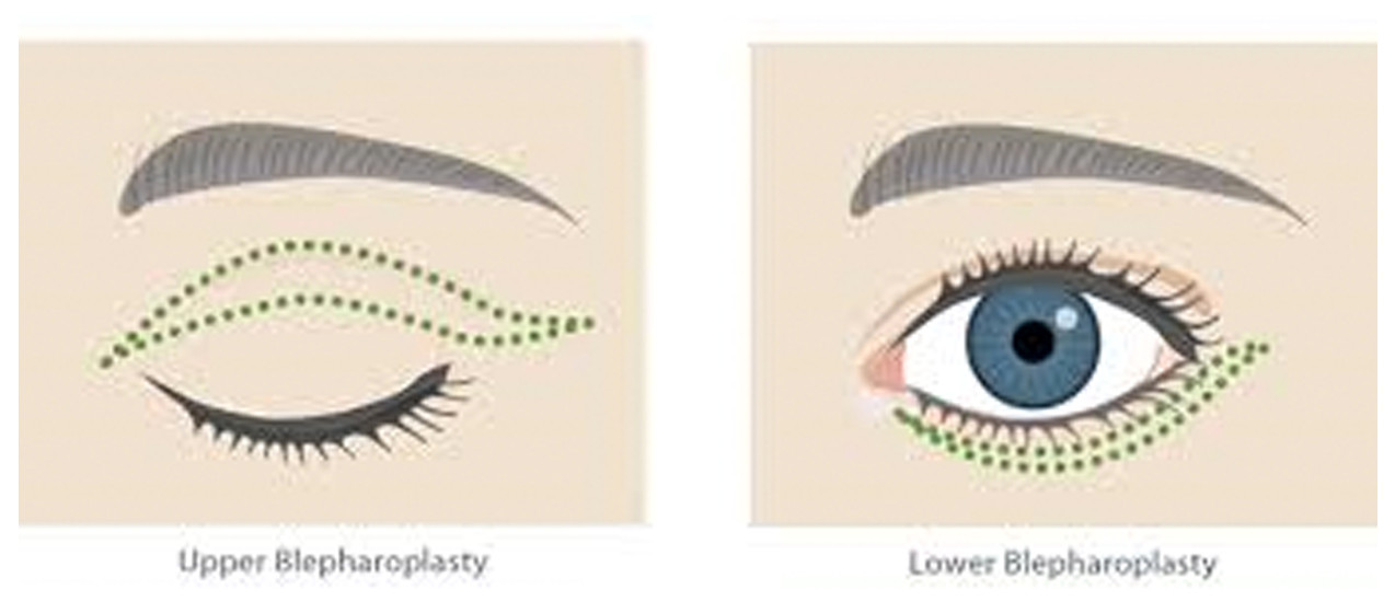 Blepharoplasty in DC