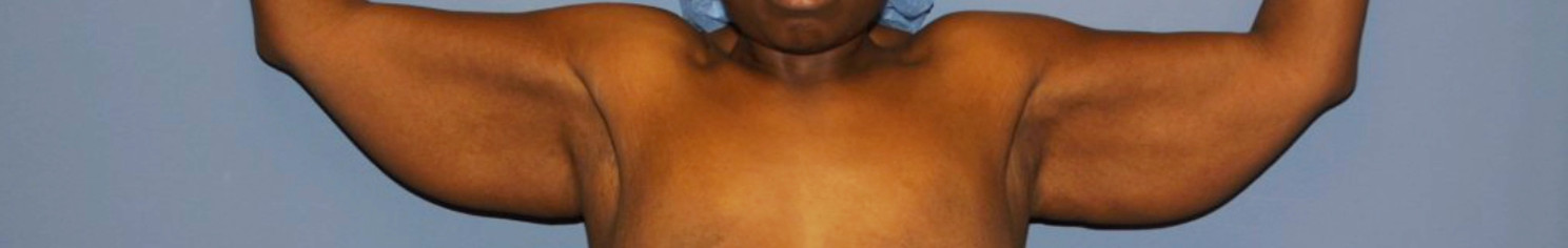 Brachioplasty in Maryland