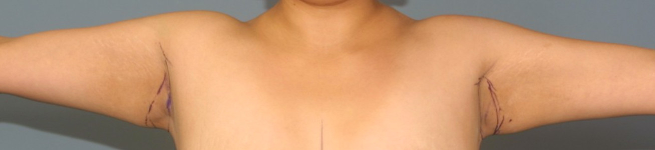 Brachioplasty Short Scar