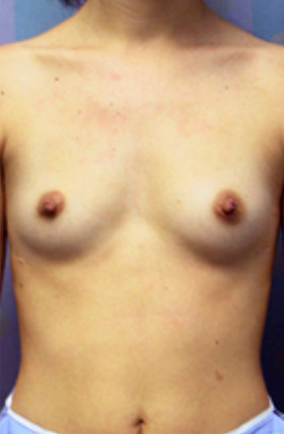 Breast Enhancement Before Picture