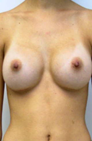 Breast Enhancement After Picture