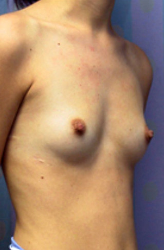 Breast Enlargement Before Picture