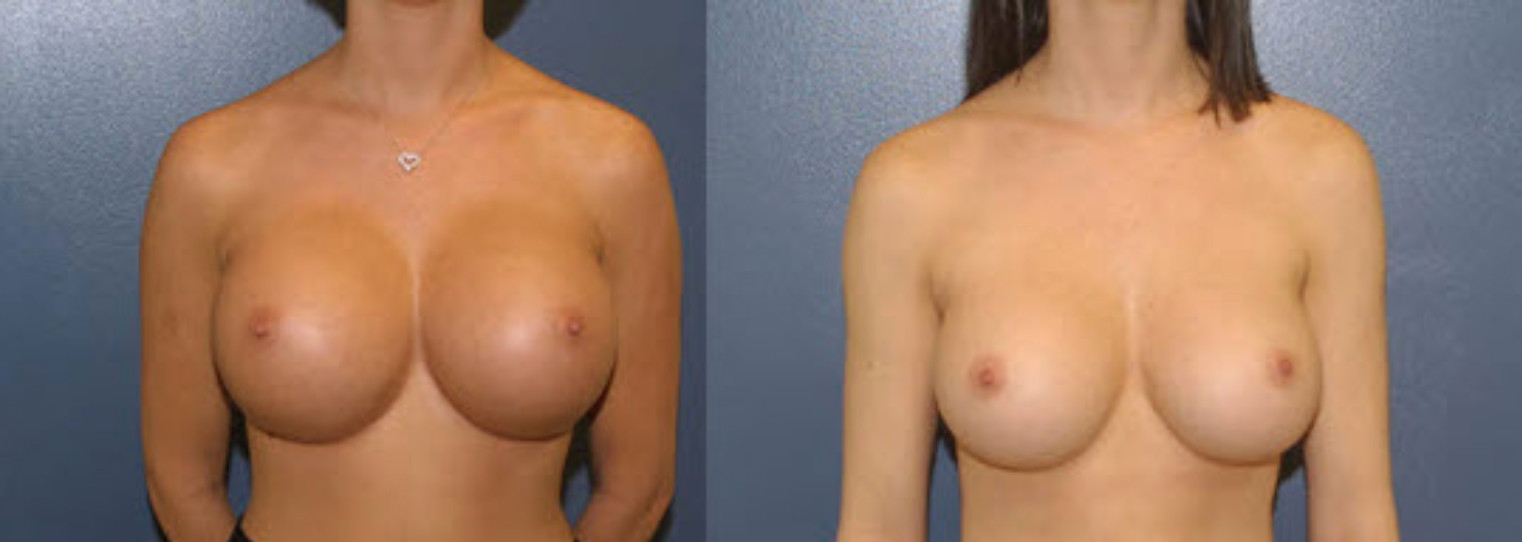 Unshapely Breast Enhancement