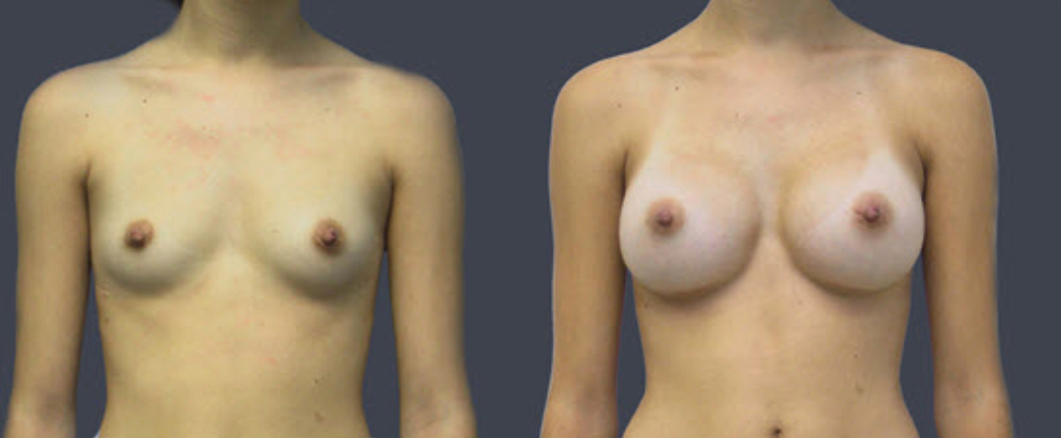 Annapolis Breast Augmentaition