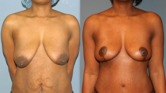 Breast Lift Surgery in Virginia