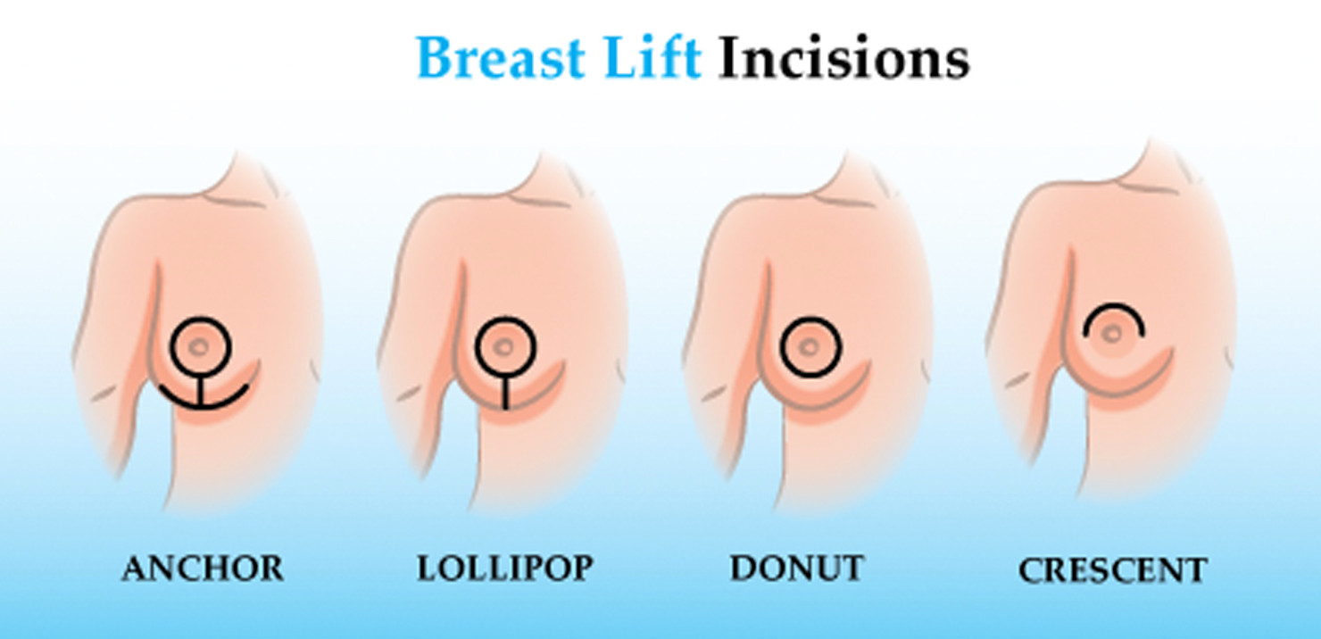 Breast Lift Incisions