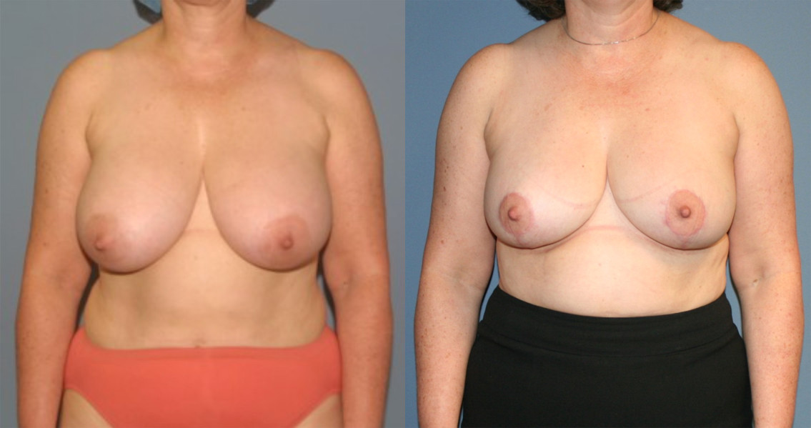 Breast Reduction in Annapolis