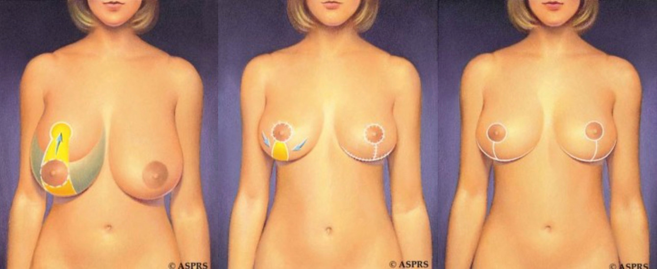 Breast Reduction Surgery