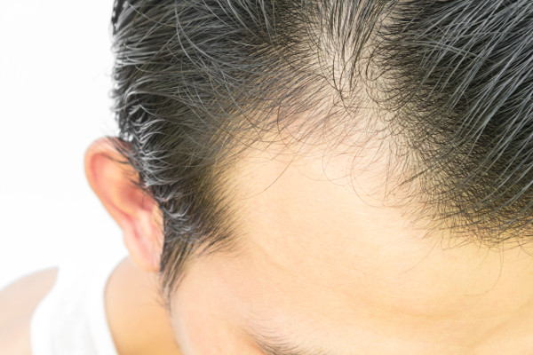 Hair follicle surgery in Maryland