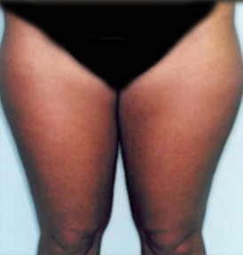 Liposuction in Virginia