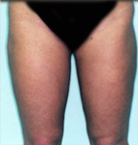 Liposuction in Maryland