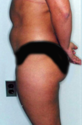 Liposuction Before