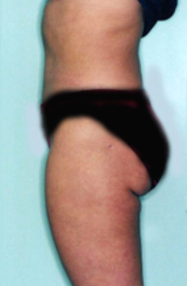 Liposuction After