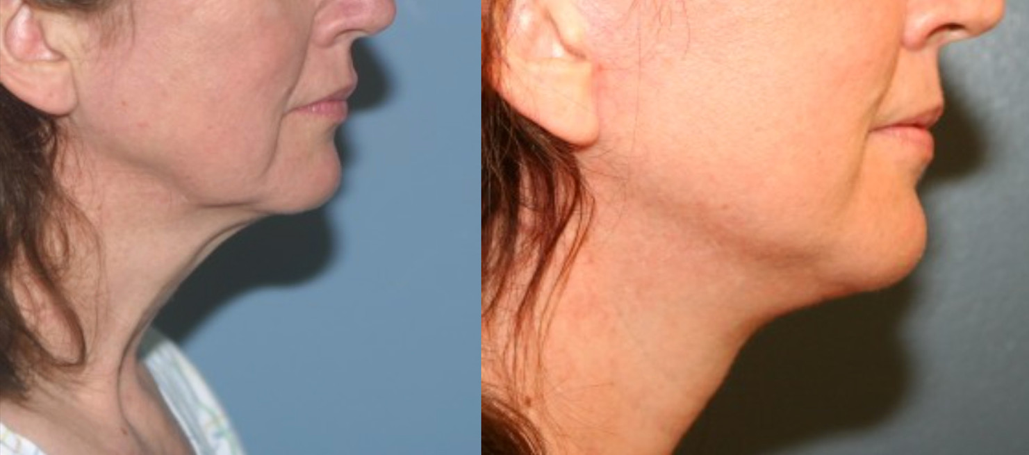 Facelift after weight loss