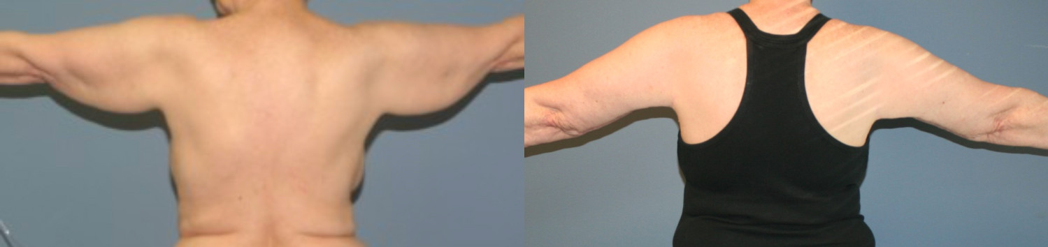 Brachioplasty after weight loss