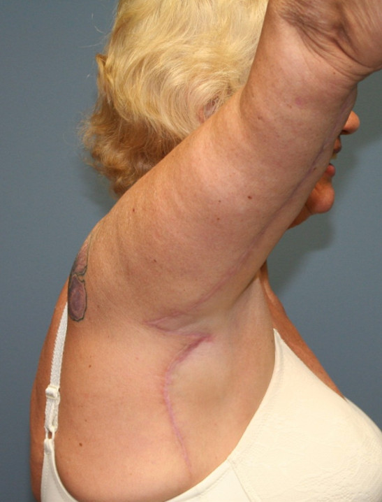 After Brachioplasty Surgery