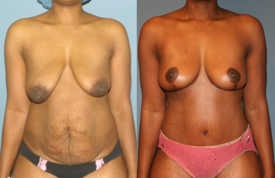 Breast Lift After Weight Loss