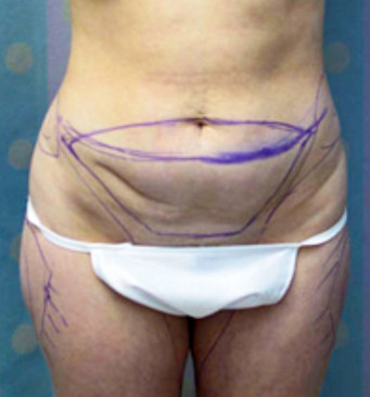 Abdominoplasty Surgery