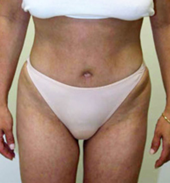 Abdominoplasty Surgeon