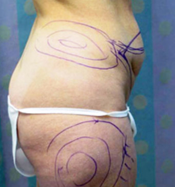 Plastic Surgeon Tummy Tuck