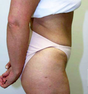 Plastic Surgery Tummy Tuck