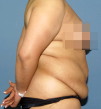 Tummy Tuck Surgical Group