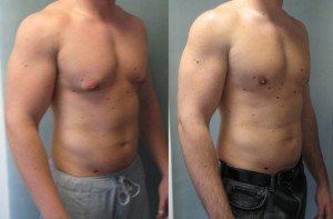 male-breast-reduction