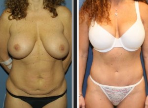 tummy tuck after weight loss