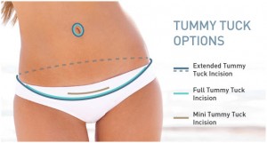 tummy tuck image