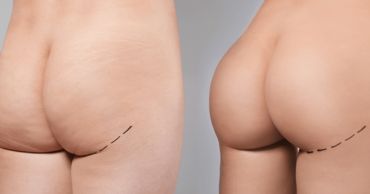 Why Butt Lifts and Augmentations are Rapidly Growing