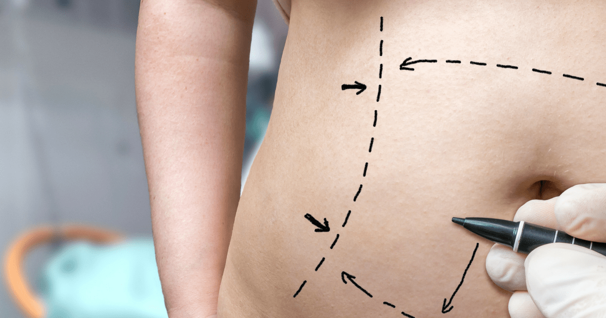 Tummy tuck vs liposuction