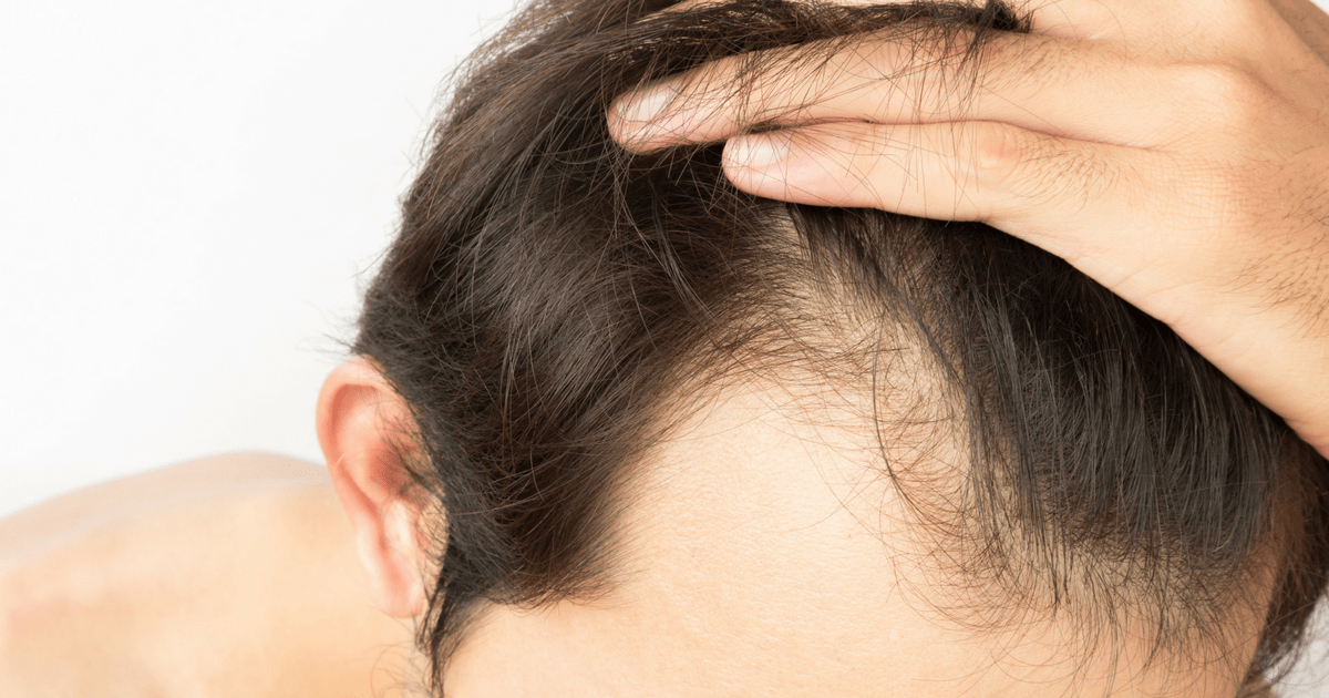 How Hair Transplants Can Change Your Life