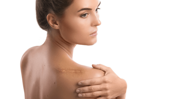 Surgery Scars What You Need to Know