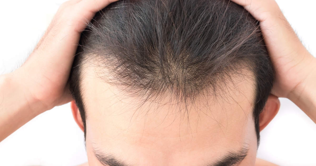 hair transplants for men