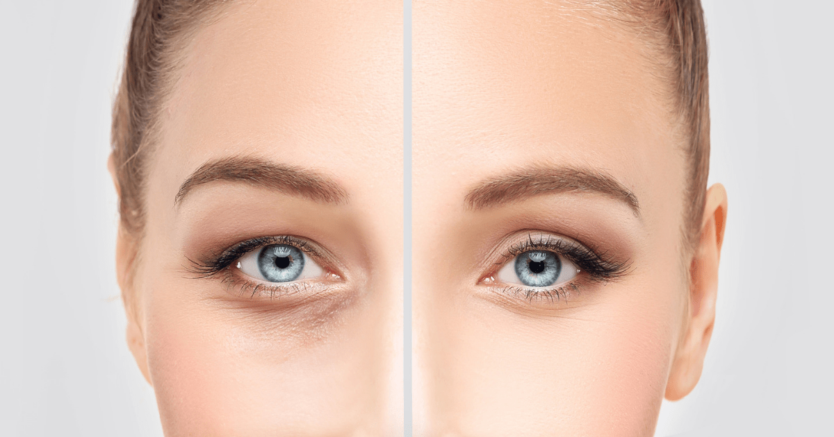 eyelid surgery