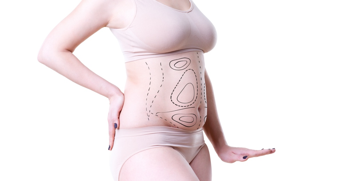 tummy tuck recovery tips