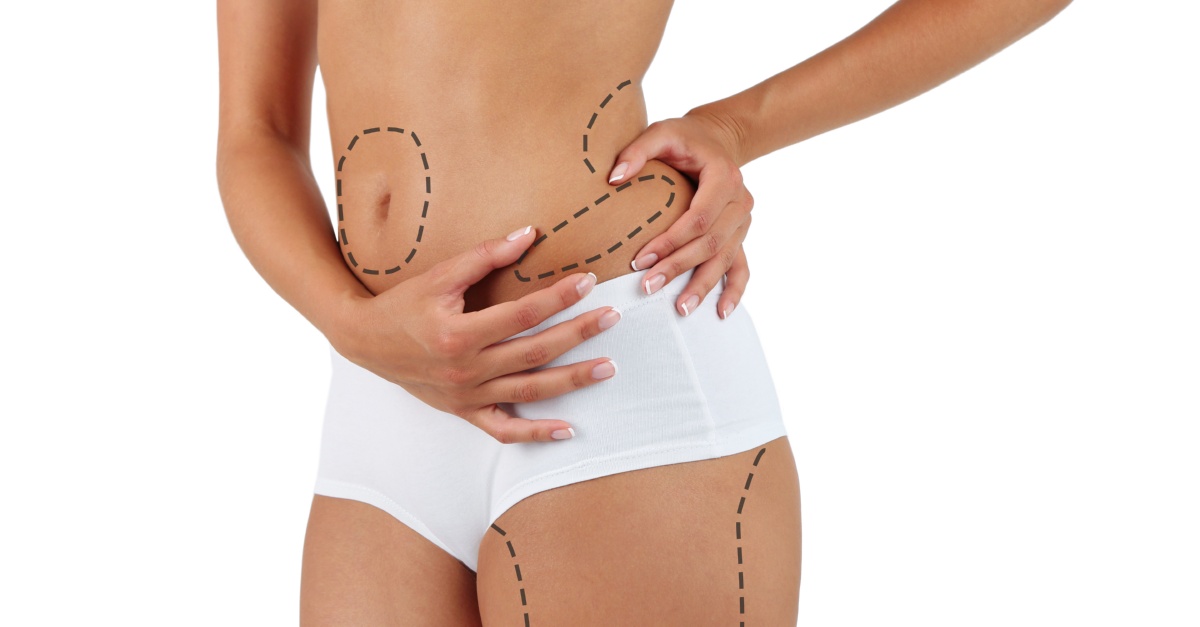 liposuction procedure