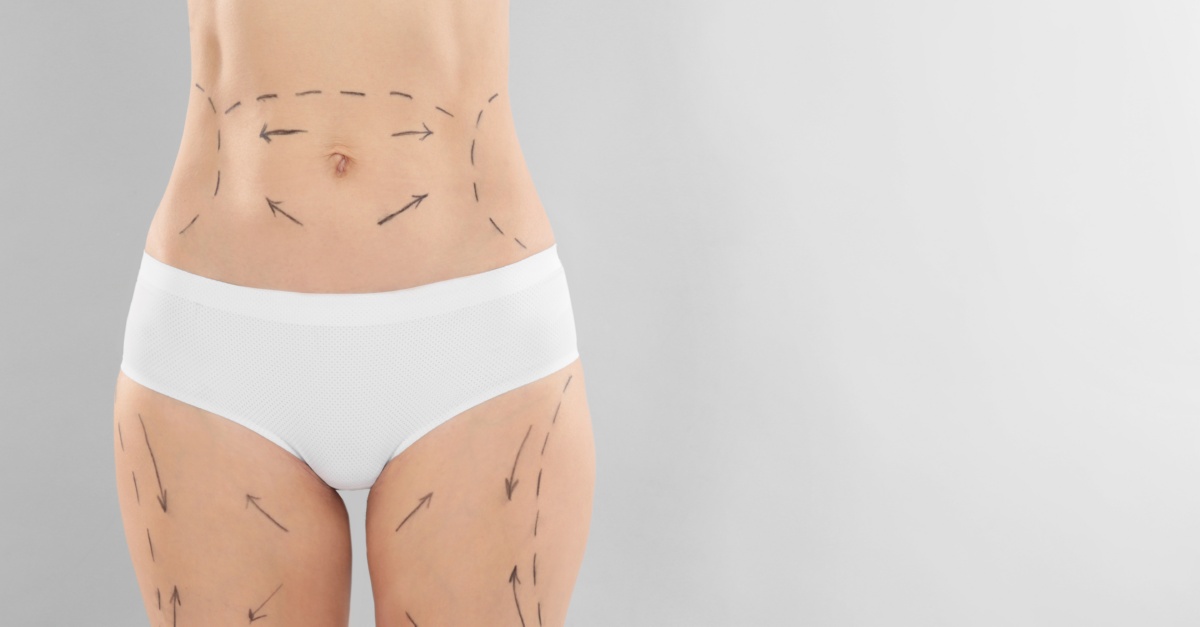 tummy tuck vs liposuction