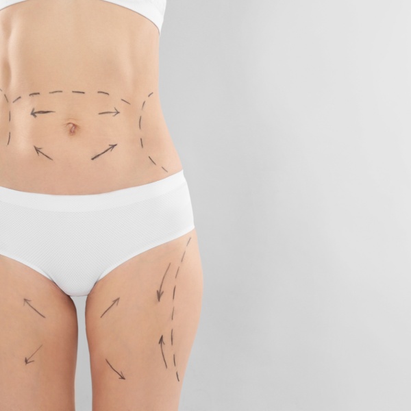 tummy tuck vs liposuction 